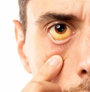 Как жить с синдромом Жильбера и не испытывать симптомов