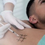 Эффект от лазерного лечения гипергидроза